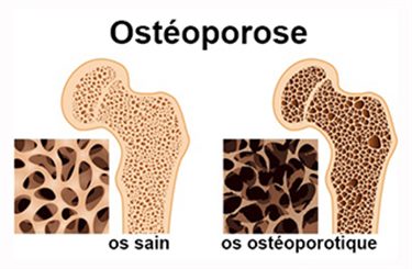 ostéoporose
