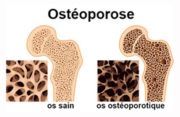 Prévention et traitement de l'ostéoporose