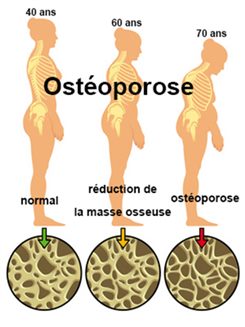 ostéoporose