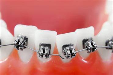 Orthodontie dentaire
