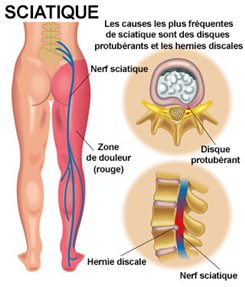 Épididymite : symptômes, traitement, définition - docteurclic.com