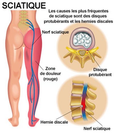 Traitement de sciatique