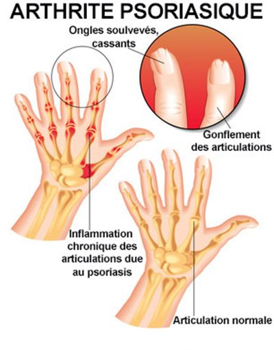 inflamatii articulare