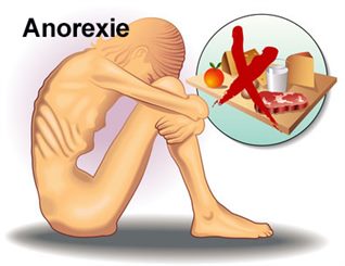 anorexie