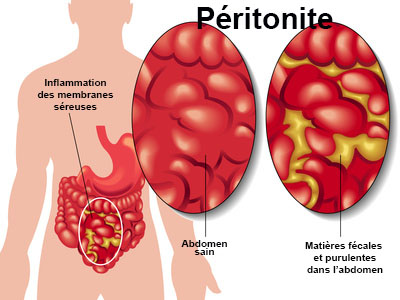 Péritonite : symptômes, traitement, définition - docteurclic.com