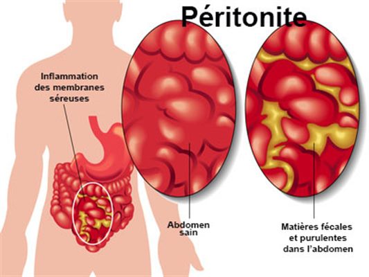 Péritonite