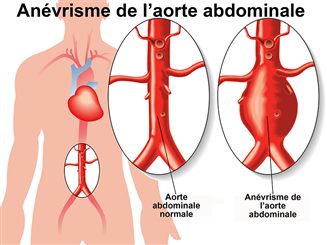 anévrisme aorte abdominale