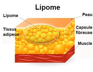 Lipome