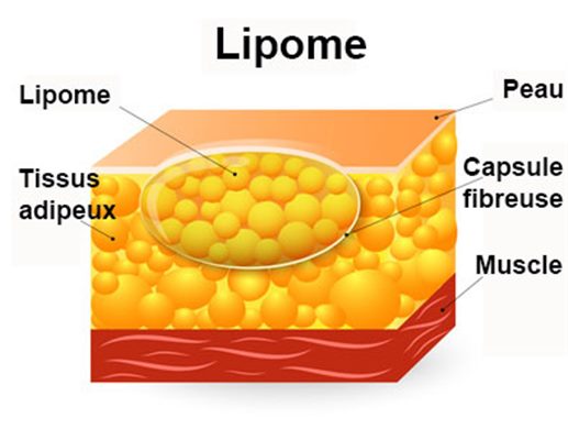 Lipome : symptômes, traitement, définition - docteurclic.com