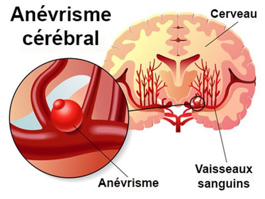 Anévrisme cérébral