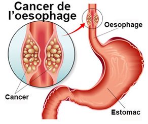 Dysphagie : mal en avalant : symptômes, traitement, définition ...