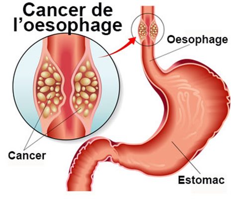 Tumeur de l'oesophage