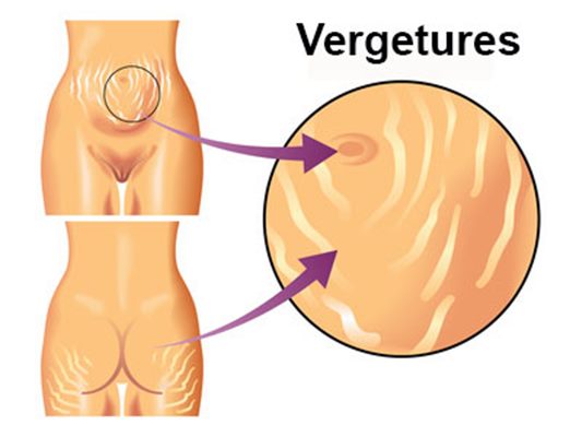 Vergetures : symptômes, traitement, définition 