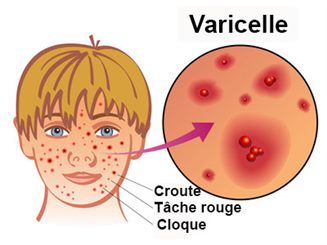 varicelle
