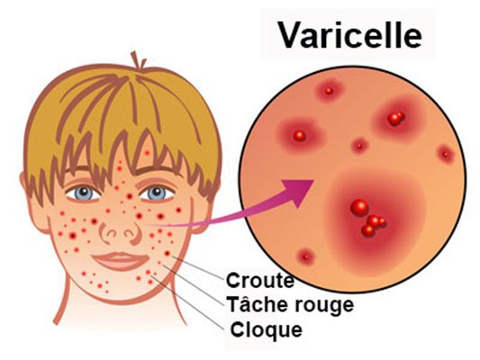 Varicelle : des réponses à vos questions