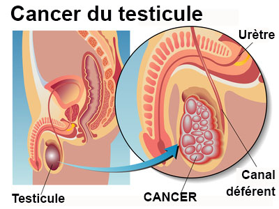 Cancer du testicule : symptômes, traitement, définition ...