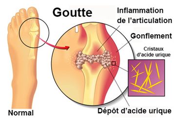 goutte