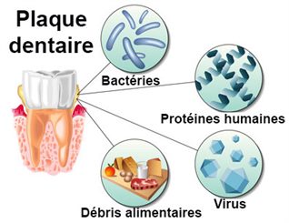 plaque dentaire