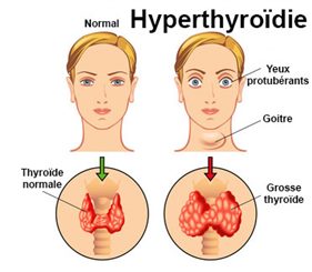 hyperthyroïdie