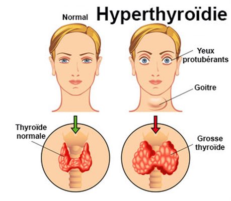 Thyroide gonflee