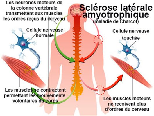 Sclérose latérale amyotrophique (maladie de Charcot)