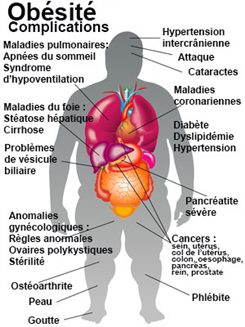 obésité