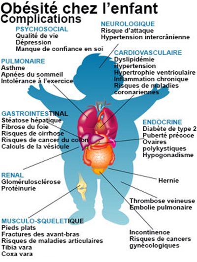 Obésité de l'enfant