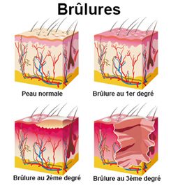 brûlure