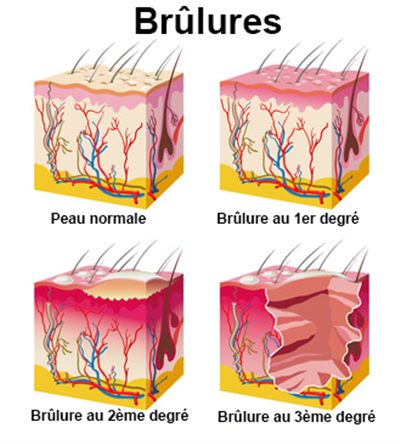 Résumé sur les brûlures. Image_5752_400