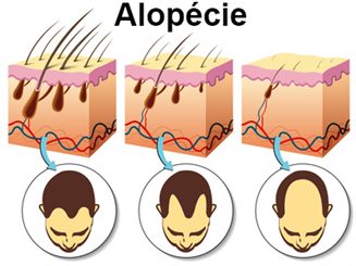 alopécie