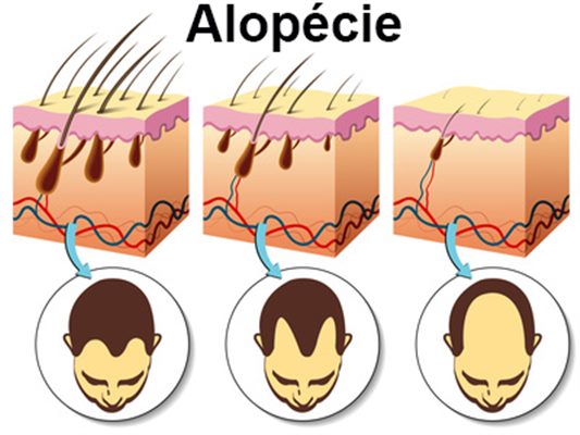 Alopécie