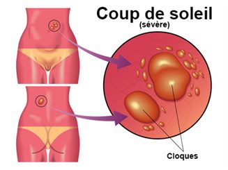 coup de soleil