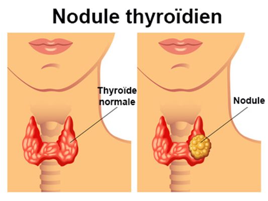 Nodule thyroïdien