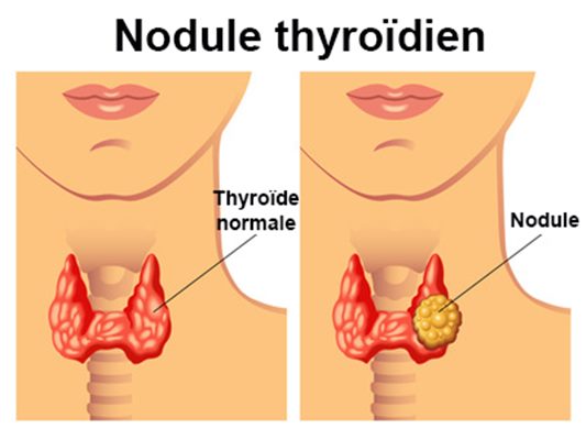 Nodule thyroïdien : symptômes, traitement, définition ...