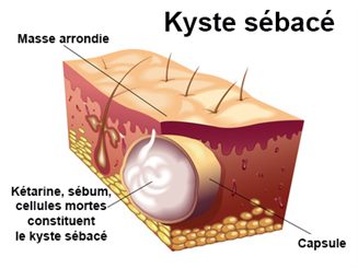 kyste sébacé