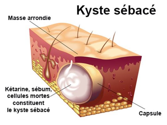 Percer kyste sebace