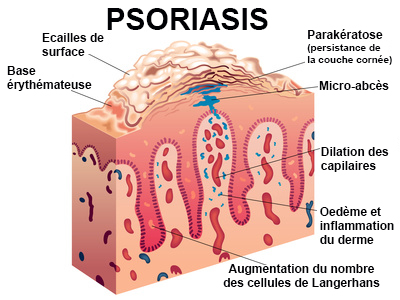 Psoriasis : symptômes, traitement, définition - docteurclic.com