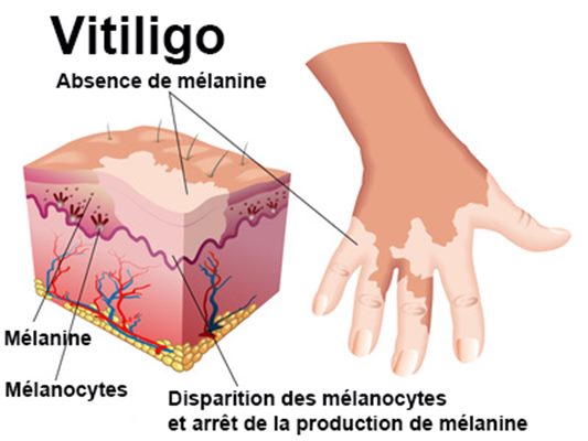 Vitiligo : symptômes, traitement, définition - docteurclic.com