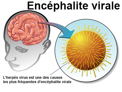 Encephalite Symptomes Traitement Definition Docteurclic Com