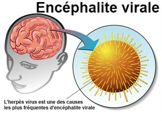 encéphalite virale