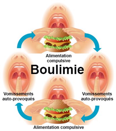 Boulimie : symptômes, traitement, définition - docteurclic.com