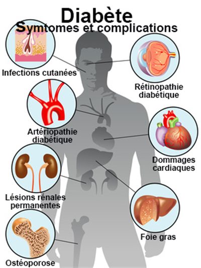 Devenir diabétique : des réponses à vos questions : faq santé 