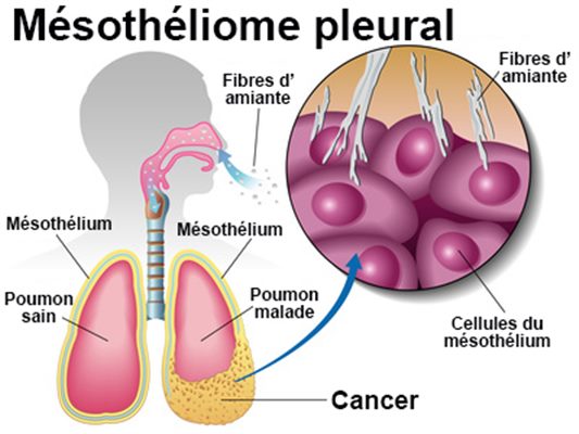 Cancer de la plèvre