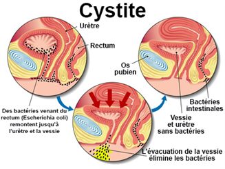 Cystites : symptômes, traitement, définition - docteurclic.com