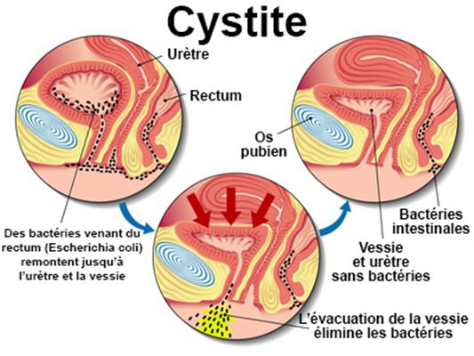 Eliminar bacterias intestinales