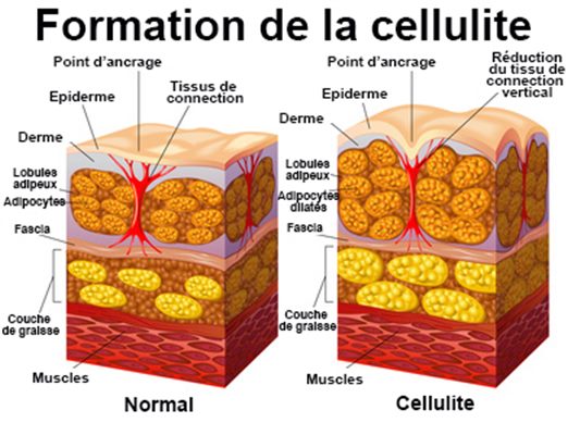 Cellulite