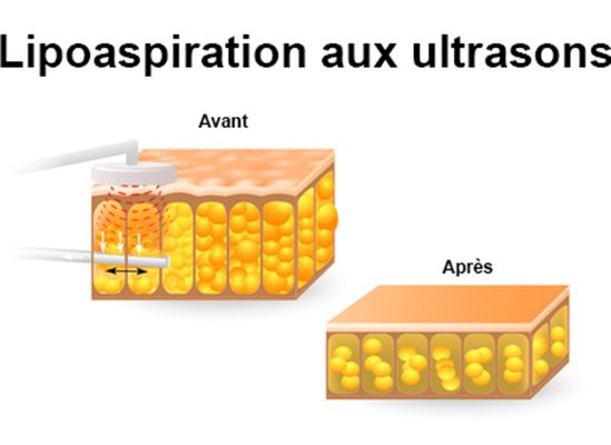 Liposuccion