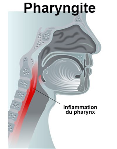 Pharyngite de l'adulte