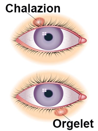 Chalazion