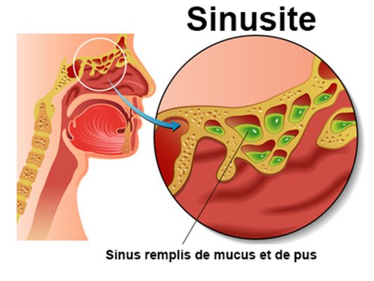 Sinusite : symptômes, traitement, définition - docteurclic.com